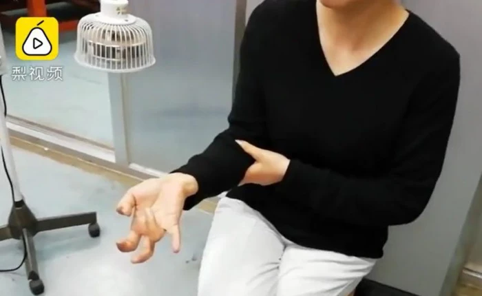 Người phụ nữ Trung Quốc suýt liệt tay vì cầm khư khư smartphone cả tuần liền