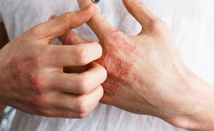 Tai họa đến từ cuộc sống hiện đại mang tên: Dị ứng thực phẩm