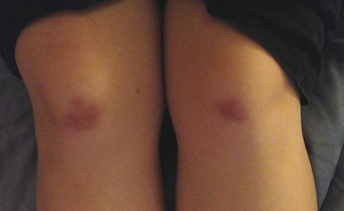 Tại sao một số người hay bị bầm tím trên da, nó có nguy hiểm không?