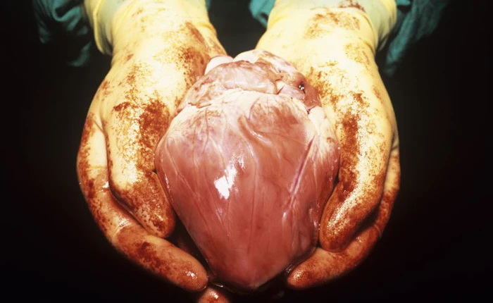 Lá gan được ghép cho cha đẻ của Apple, Steve Jobs đã khiến cả nước Mỹ nghĩ lại về hệ thống ghép tạng không cân đối nơi đây