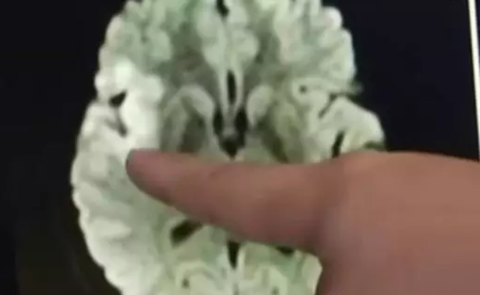 Người phụ nữ Trung Quốc bị tụ máu não vì nhìn chằm chằm vào điện thoại 20 giờ liên tục