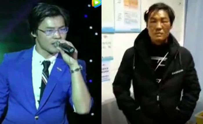 Gối sưởi phát nổ trong đêm, nam ca sĩ có nguy cơ bị hủy hoại sự nghiệp sau khi mặt bỏng nghiêm trọng