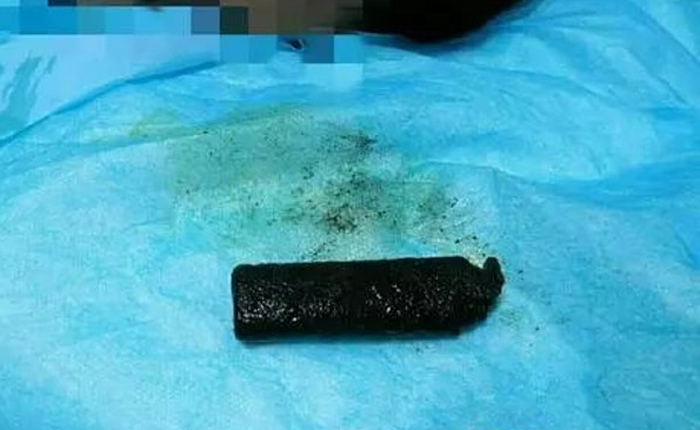 Bác sĩ lấy ra chiếc bật lửa bệnh nhân đã nuốt 20 năm trước, kết quả sẽ khiến bạn rợn tóc gáy