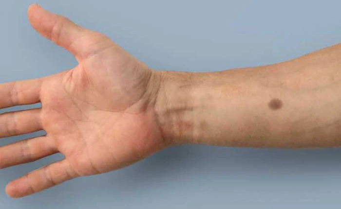 Phương pháp cấy ghép sinh học này sẽ làm xuất hiện nốt ruồi nhân tạo khi phát hiện có ung thư