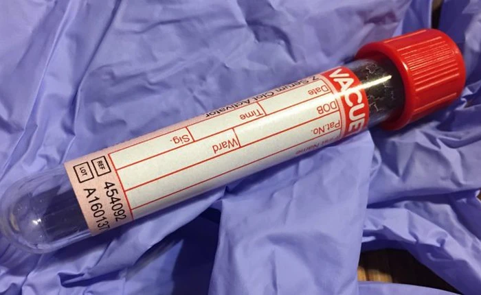 Xét nghiệm máu có thể là cứu cánh mới trong nghiên cứu ung thư