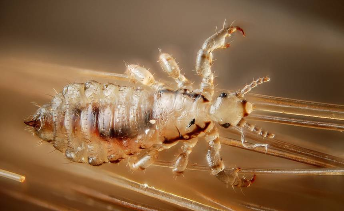 Dùng thuốc trừ sâu để gội đầu diệt chấy, người đàn ông Trung Quốc nhập viện vì nhiễm độc thần kinh