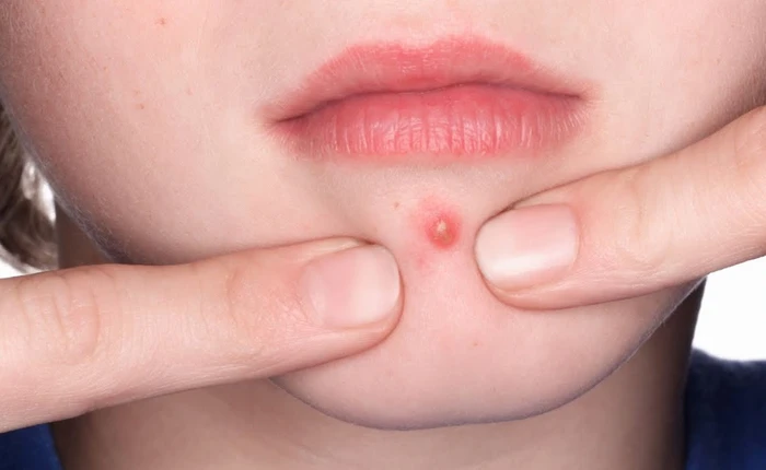 Vì nghiện nặn mụn mà có người phụ nữ mất cả trí nhớ, xin giới giới thiệu 7 bước để bạn nặn mụn an toàn nhất