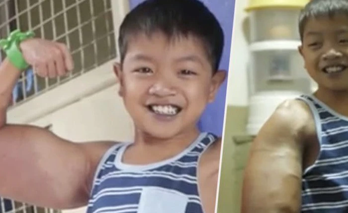 Căn bệnh hiếm gặp đã khiến tay trái của cậu bé Phillipines bỗng to lên bất thường, tuy nhiên em không hề tự ti với bắp tay kì lạ đó