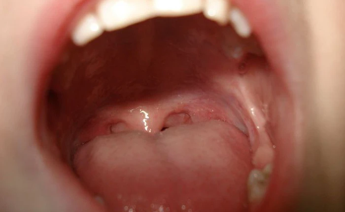 Tại sao mọi vết thương trong miệng đều lành rất nhanh?