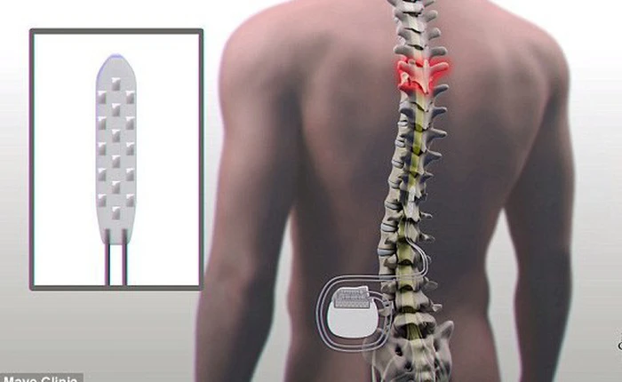 Lần đầu tiên bệnh nhân liệt cột sống có thể đi lại - đột phá khiến cả thế giới phải sửng sốt