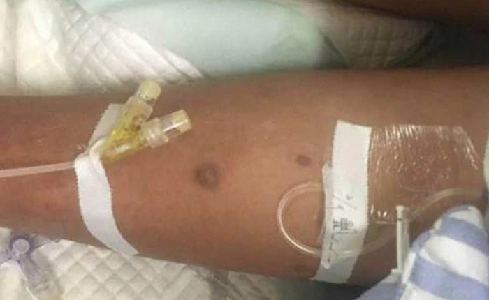 Trung Quốc: 1 người tử vong, 1 người nguy kịch vì bị 50 con ong vò vẽ đốt khi đi săn ấu trùng