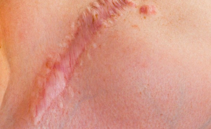 Các nhà khoa học tìm ra cách chữa lành vết thương mà không để lại sẹo