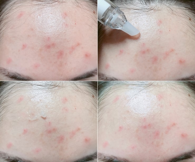 Trị sạch mụn sau 14 ng&agrave;y, thanh kim ti&ecirc;m n&agrave;y hot tới nỗi con g&aacute;i H&agrave;n thi nhau sử dụng - Ảnh 8.