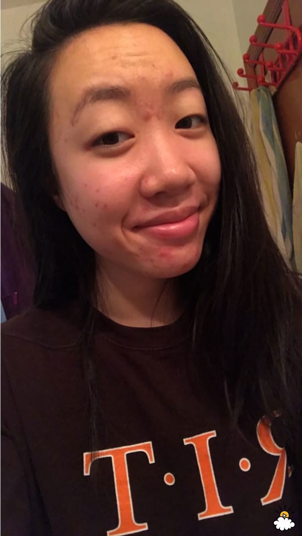 Thoa dầu dừa l&ecirc;n da trong 1 tuần để chữa sẹo mụn, c&ocirc; n&agrave;ng n&agrave;y đ&atilde; nhận được kết quả đ&aacute;ng thất vọng - Ảnh 4.