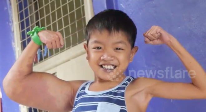 Căn bệnh hiếm gặp đ&atilde; khiến tay tr&aacute;i của cậu b&eacute; Philippines bỗng to l&ecirc;n bất thường, tuy nhi&ecirc;n em kh&ocirc;ng hề tự ti với bắp tay k&igrave; lạ đ&oacute; - Ảnh 2.