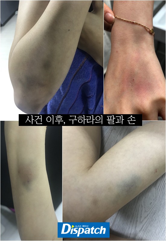 Dispatch b&oacute;c mẽ vụ h&agrave;nh hung chấn động: Goo Hara bị chảy m&aacute;u tử cung, &acirc;m đạo, bầm t&iacute;m cả người v&igrave; bạn trai đ&aacute;nh - Ảnh 2.
