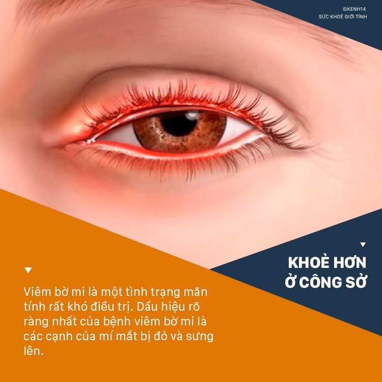 Đ&acirc;y l&agrave; căn bệnh m&agrave; d&acirc;n văn ph&ograve;ng n&agrave;o cũng phải đối mặt khi l&agrave;m việc với m&aacute;y t&iacute;nh suốt nhiều giờ - Ảnh 2.