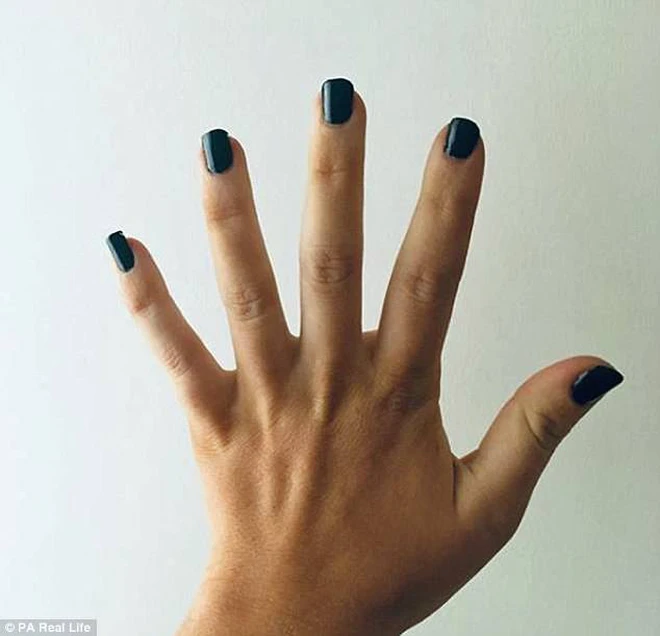 C&ocirc; g&aacute;i 26 tuổi bị ph&igrave;nh to tay ch&acirc;n bất thường v&agrave; nguy&ecirc;n nh&acirc;n lại xuất ph&aacute;t từ căn bệnh m&agrave; con g&aacute;i rất dễ mắc phải - Ảnh 3.